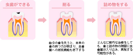 一般的な虫歯治療とその後